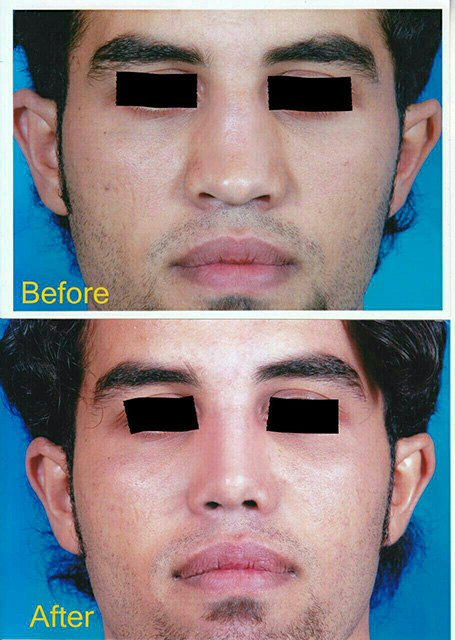 جراحی بینی گوشتی-مشهد