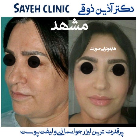 جراحی لیفت صورت در مشهد